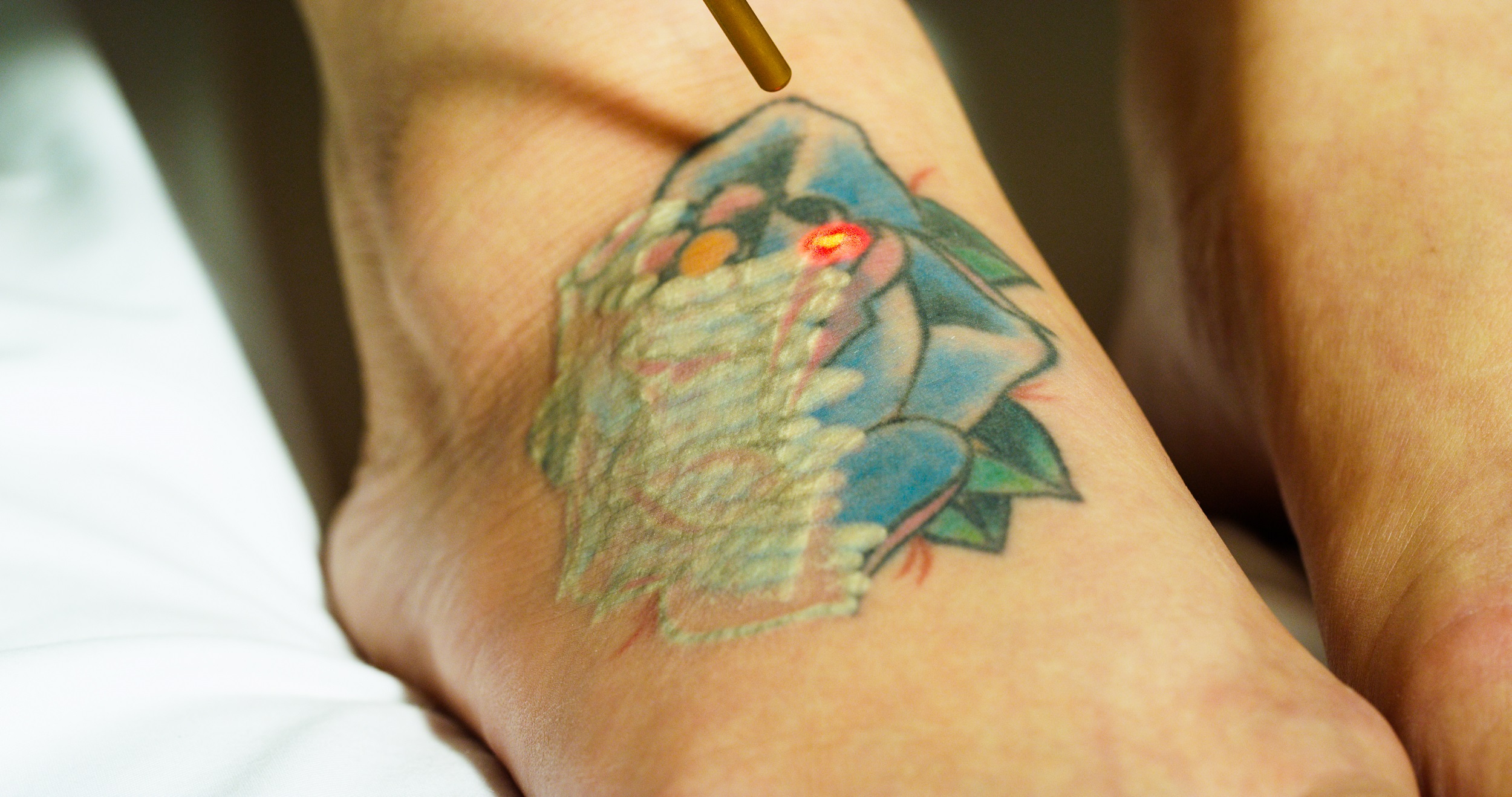 Phaze Laser Tattoo Removal Brings Trinity Multicolored Laser Tattoo 